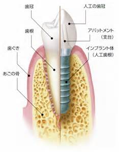 インプラント.jpg